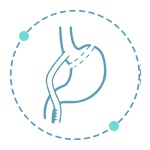 Mini Gastrik Bypass Ameliyatı